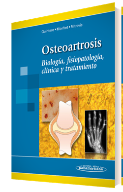 OSTEOARTROSIS